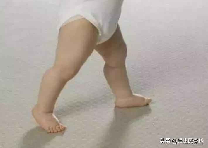 小孩扁平足已经影响走路了怎么办,多大孩子可以判断是扁平足