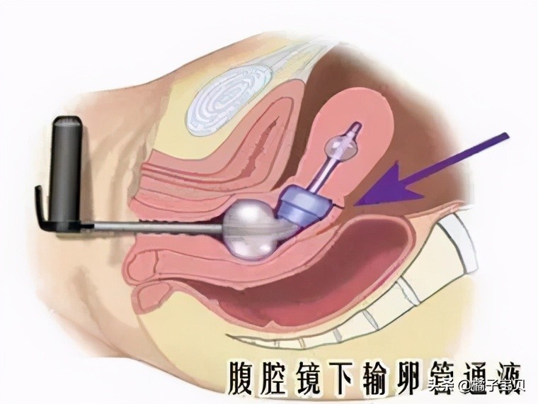 输卵管堵塞了该如何检查？