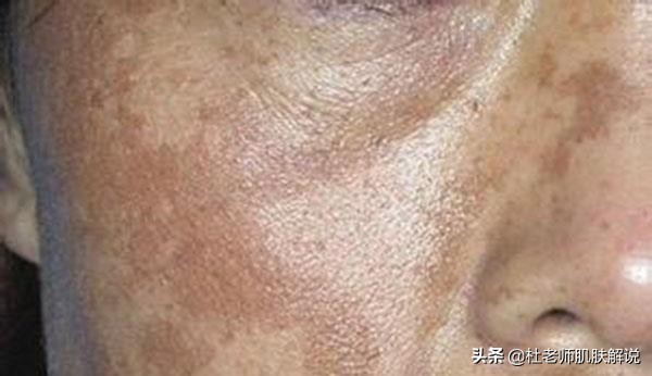 脸上长褐斑是什么原因如何解决,脸上褐斑越来越多怎么回事