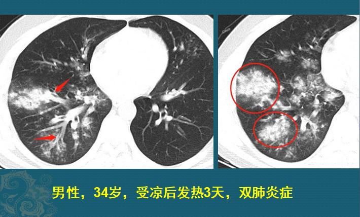 流感合并细菌感染好治疗吗,流感病毒肺炎怎么治疗