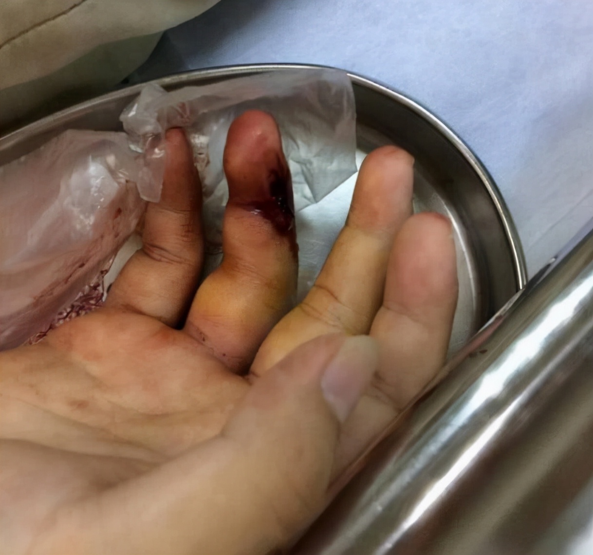 被竹叶青毒蛇咬了严重吗,小孩被竹叶青蛇咬伤