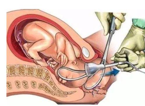 生宝宝难产疼得要死怎么办,生孩子难产差点死掉是什么经历