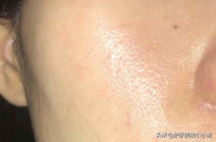 痘痘毛孔粗大爱出油正确护肤步骤,油性皮肤毛孔粗大去痘印护肤品