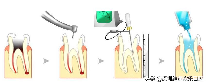 根管治疗几次了牙齿还是会痛,根管治疗不彻底多久会复发