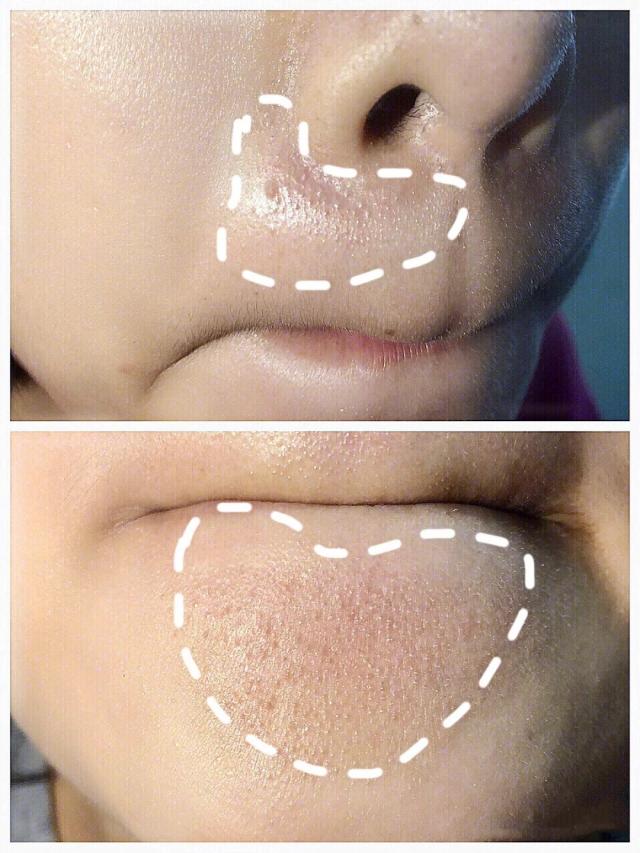 闭口挤了一直长怎么办,闭口到底要不要挤出来