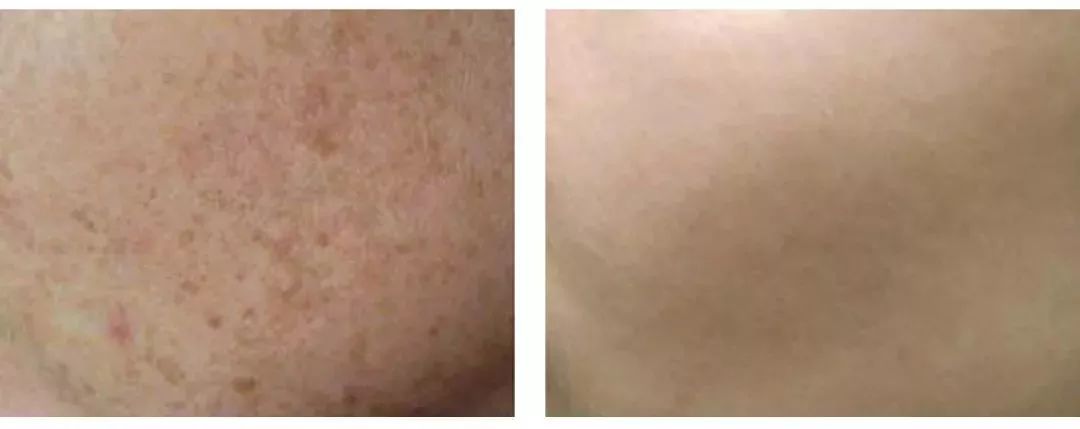 嘴周围皮肤发黄暗沉是什么原因,如何改善皮肤暗沉发黄黑色素沉着