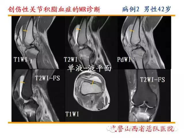 膝关节炎髌上囊积液自己看得出吗,髌上囊有积液膝盖会走路无力吗