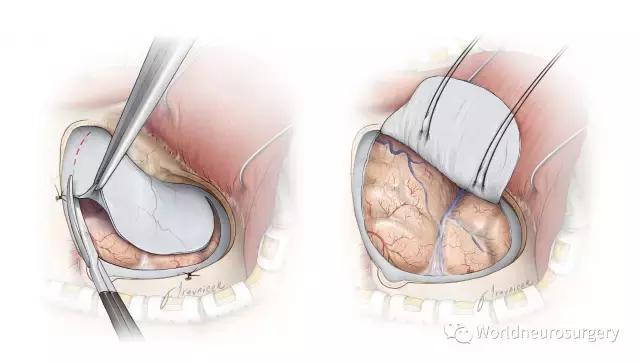 翼点入路的开颅要点,翼点开颅详解图