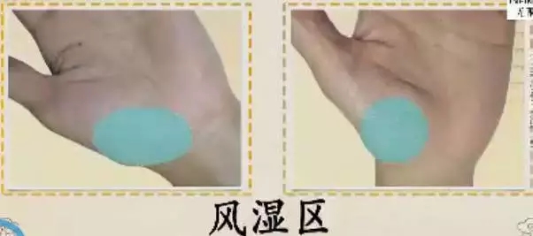 手的健康识别,看手识病疾病自测