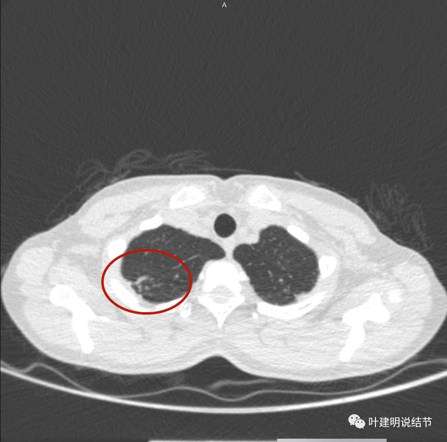 临床诊断孤立性肺结节,空洞型结节一般是什么性质