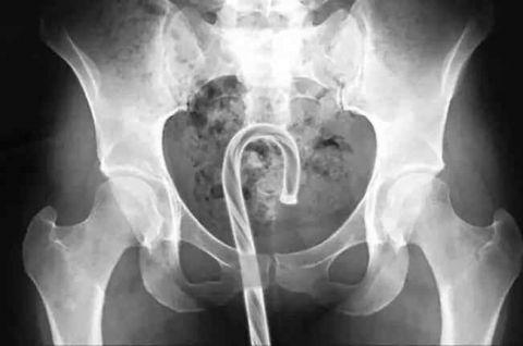 不作死就不会死,看看这些被人类搞进身体里的异物