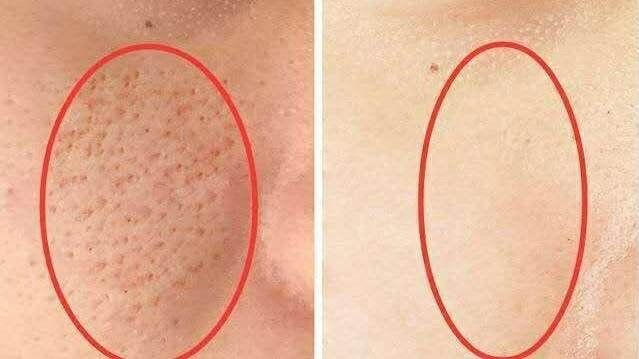 脸部毛孔粗大有什么办法改善,如何改善面部皮肤毛孔粗大