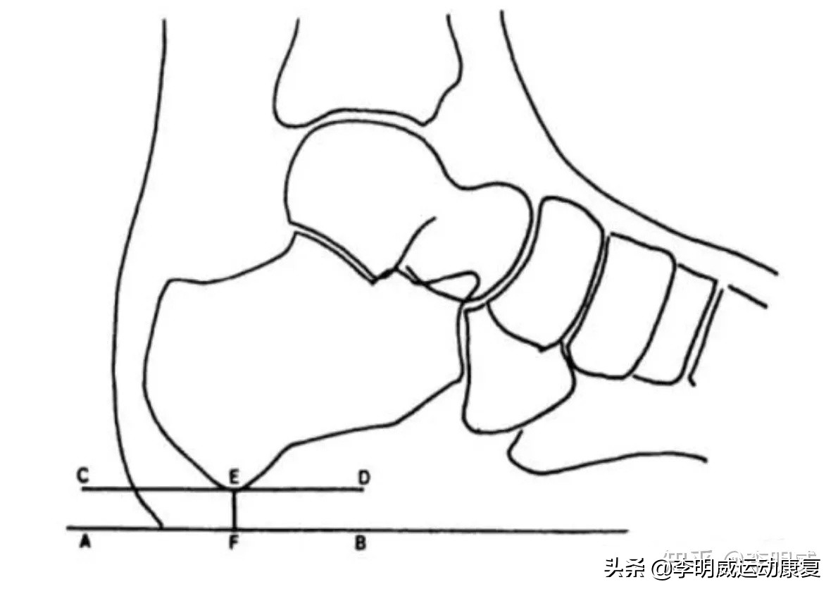 老年人足跟痛如何治疗,足跟痛的自我治疗方法