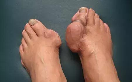 痛风吃补肾的药有用吗,痛风需要补肾还是健脾