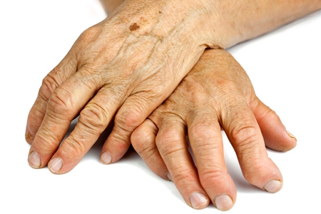 类风湿吃药总是不能根治,类风湿性关节炎微循环