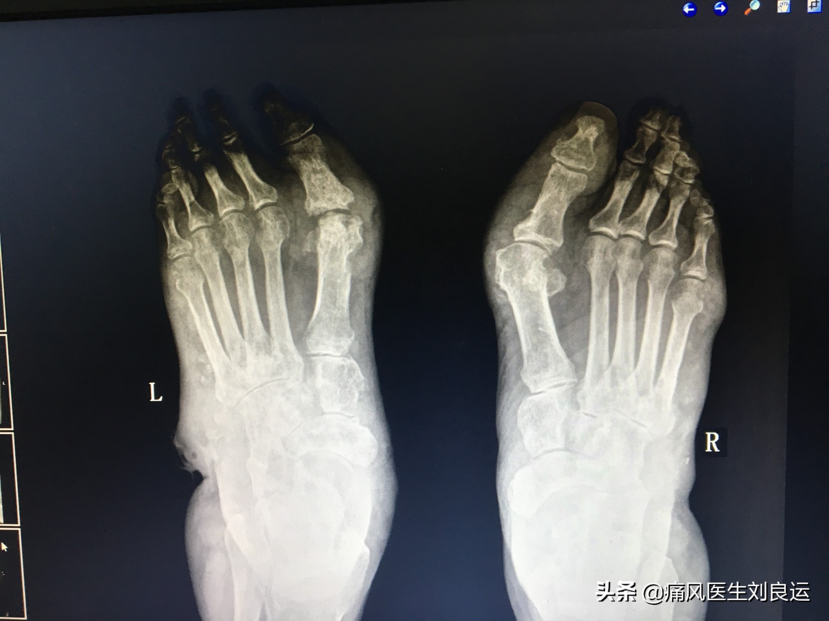 痛风石能不能手术取出,取痛风石手术是不是得消肿才能做