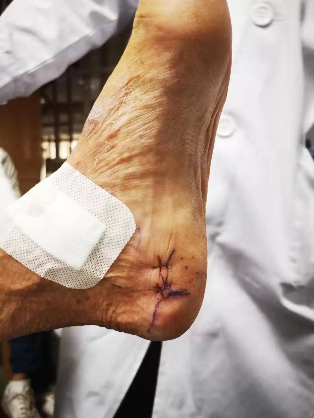 广州天河区中医院骨伤二科成功实施关节镜下跟骨骨刺摘除术