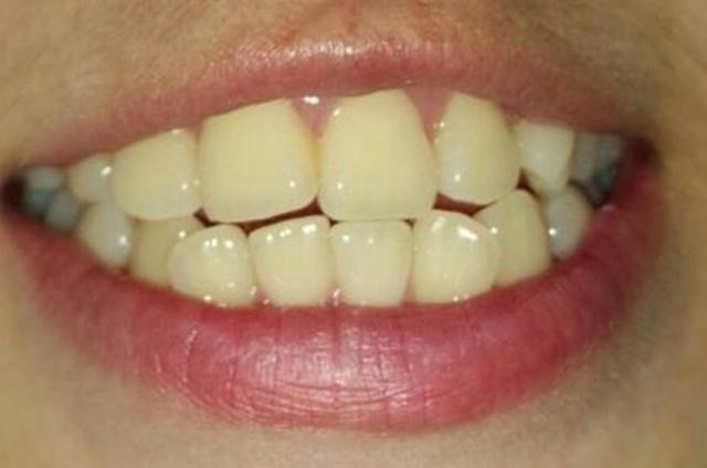 洗完牙还是黄牙怎么变白牙,牙黄怎么刷牙都不掉怎么办