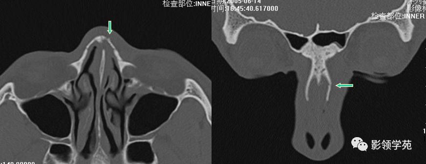 鼻骨骨折的检查方法,鼻骨骨折影像学表现