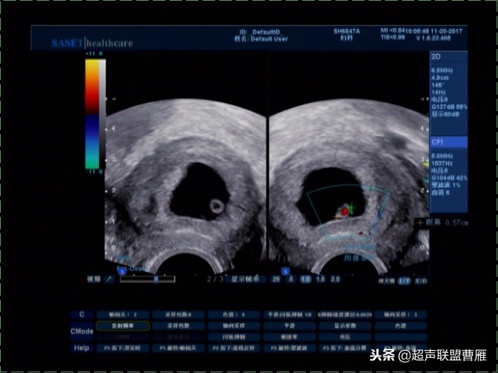 3毫米卵黄囊未见胎芽正常么,40多天的卵黄囊