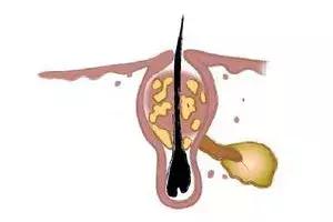 祛鼻头黑头最有效的方法,去黑头的错误做法
