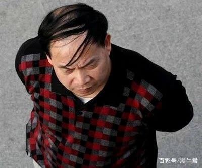 日本对秃头有什么样的治疗,让人秃头的十个方法