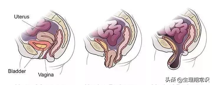 阴道里脱出块“肉”！