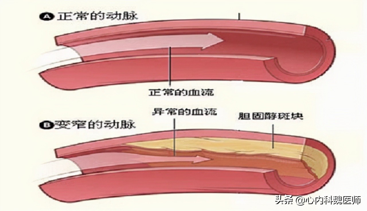 他汀的副作用肌痛怎么办,服用他汀导致的肌肉疼痛怎么缓解