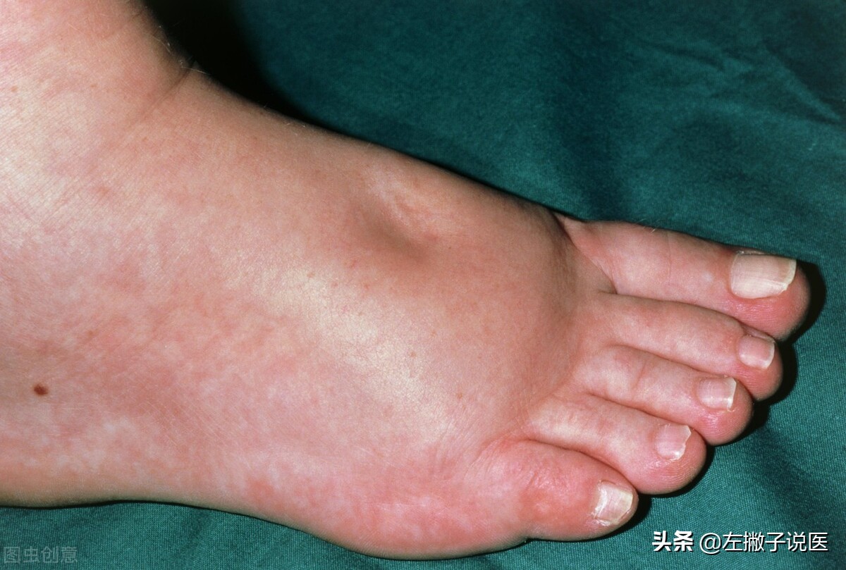 下肢水肿是气虚还是血瘀,下肢水肿是脾的问题还是肾的问题