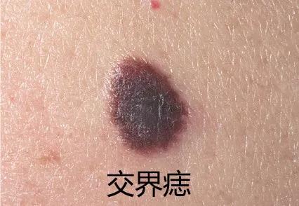 痣用点么,痣能点么