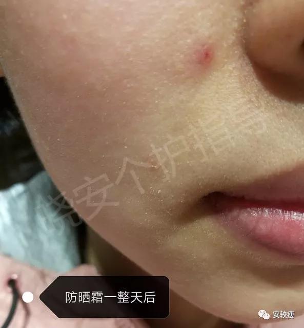 皮炎疹子干燥泛红,秋冬皮肤泛红发烫