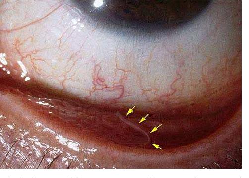女子发现一只巨型虫卵,女子眼中发现虫子