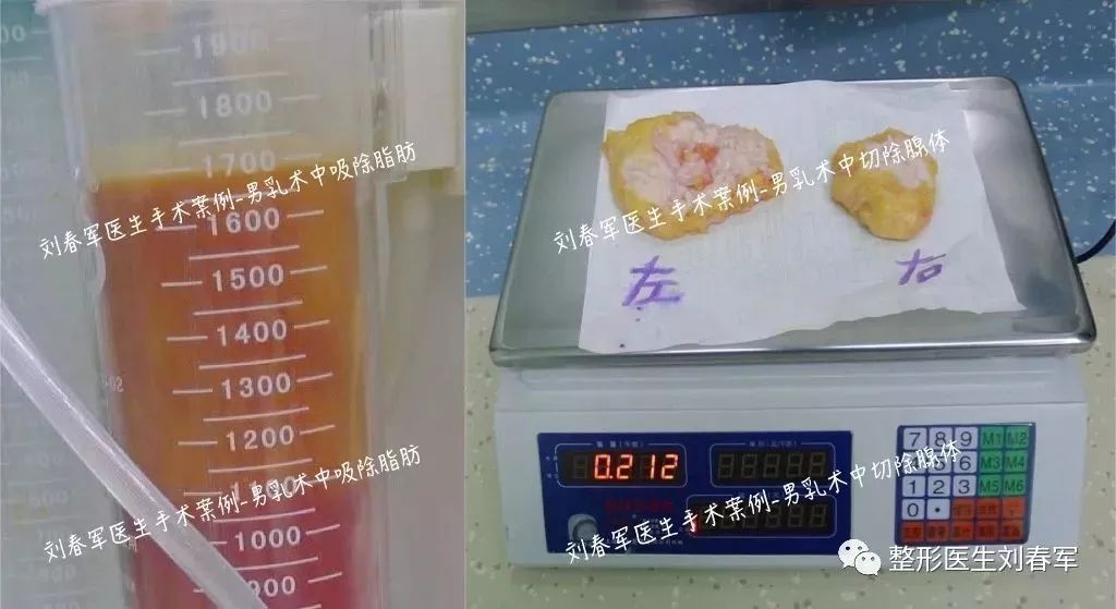 男性胸发育了怎么办,男性胸部发育了怎么办