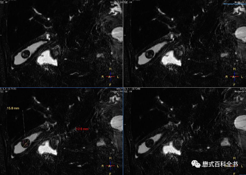 开展mrcp技术,mrcp检查操作流程
