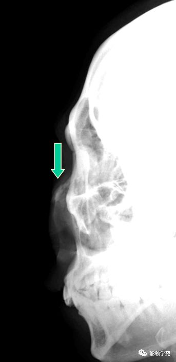 鼻骨影像学解剖,鼻骨解剖及骨折影像学诊断