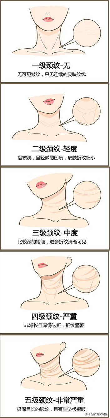 颈纹10几岁的小姑娘会有吗,颈纹一出现老十岁