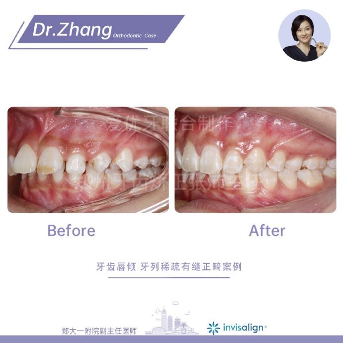 郑州矫正牙齿整形哪个医院好,郑州牙齿局部矫正