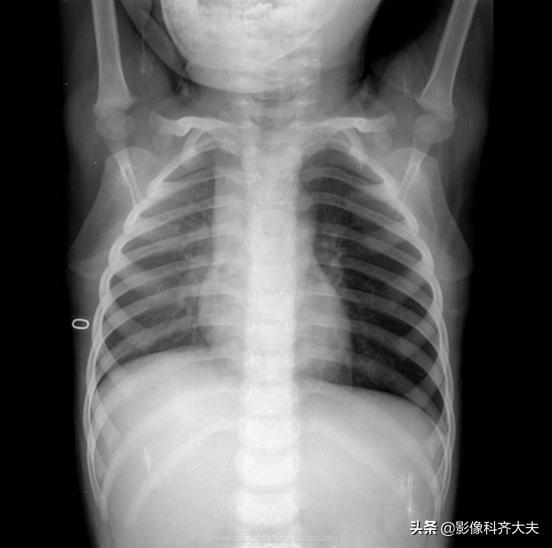 ct能查出气管微小异物嘛,气管异物ct怎么做