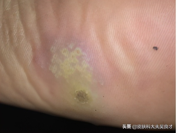 看完这篇文章后学到了什么,鸡眼和跖疣最简单的区别