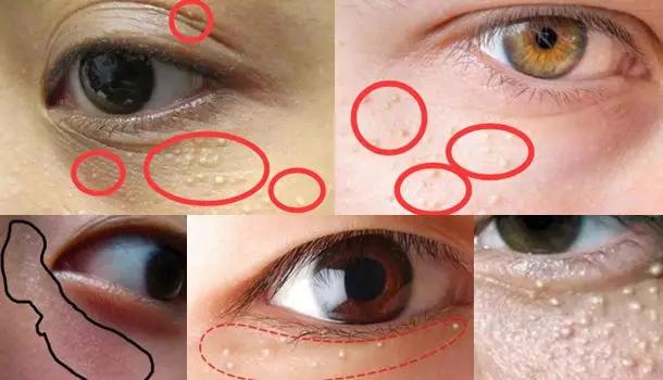 去眼纹去黑眼圈用什么方法,去眼袋黑公认最好用的土方法