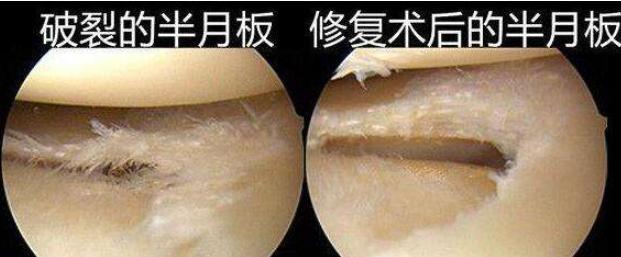关节镜半月板撕裂手术几天能出院,关节镜半月板修复术后弯曲难