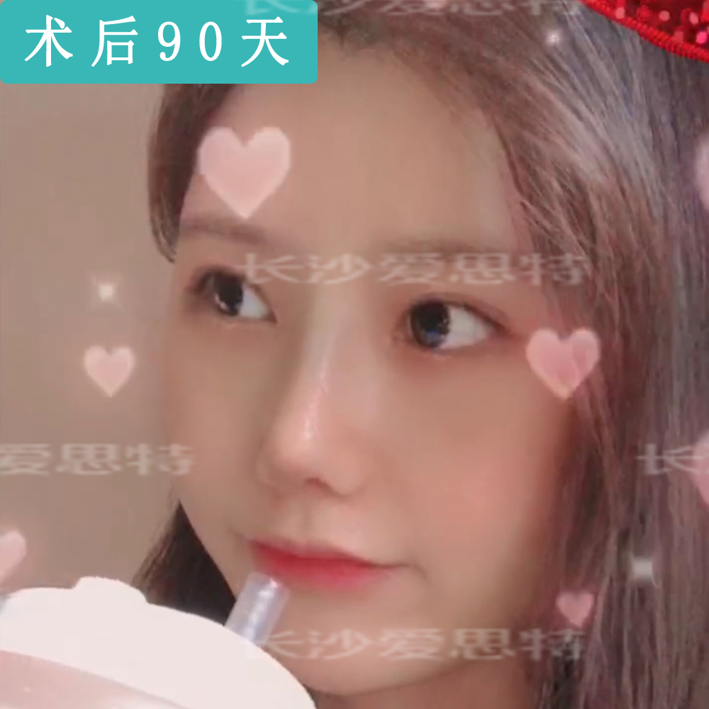 耳软骨隆鼻后吃什么恢复快,耳软骨隆鼻取出假体多久恢复原样