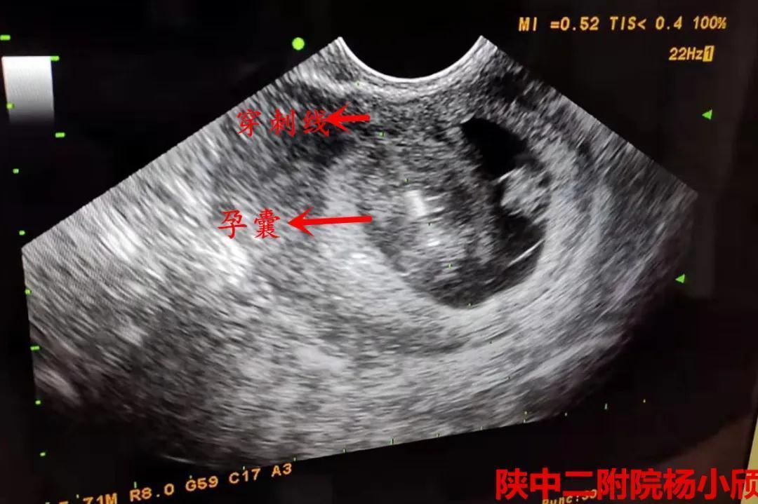 陕西中医药大学第二附属医院生殖内分泌科完成一例高难度减胎术