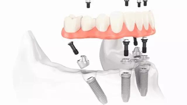 半口即刻负重种植牙过程详细步骤,即刻种植牙怎样修复牙齿的