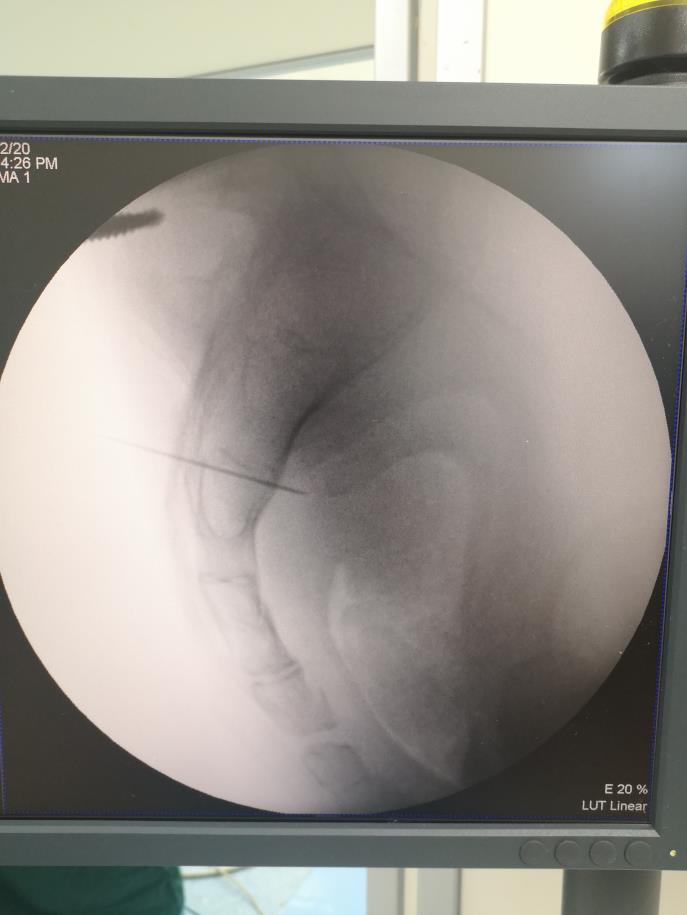 西安市红会医院成功完成机器人辅助下骶神经调节术