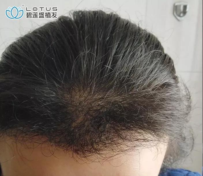 发际线后移额角大头发稀疏怎么办,额角发际线还能恢复吗
