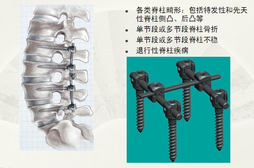 腰椎滑脱和腰椎间盘突出哪个严重,想知道腰椎间盘突出是怎样引起的