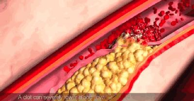 高血压昏迷不醒怎么急救,45岁男子突然晕倒2小时后离世