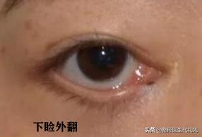 做了外切眼袋怎么消肿最快,内切去眼袋下眼睑外翻