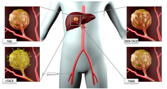 肝内神经内分泌瘤可用中药治疗吗,肝神经内分泌肿瘤的最佳治疗